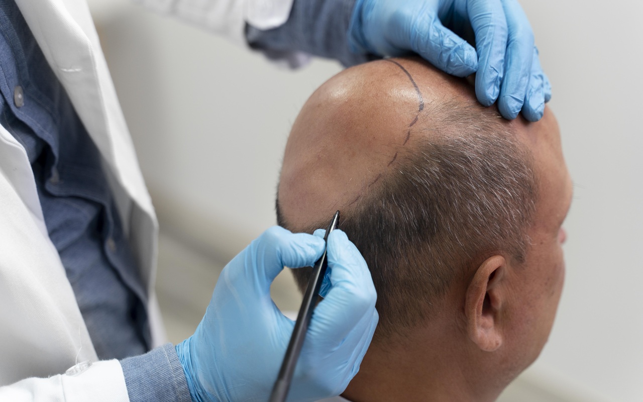 Cara Kerja Transplantasi Rambut dari Awal hingga Hasil Akhir