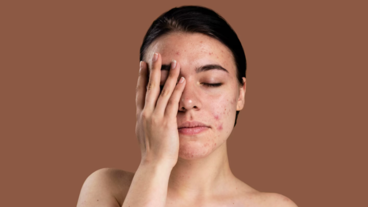 Jerawat Muncul Jangan Dipencet, Pakai B ERL Very Berry Acne Spot Treatment