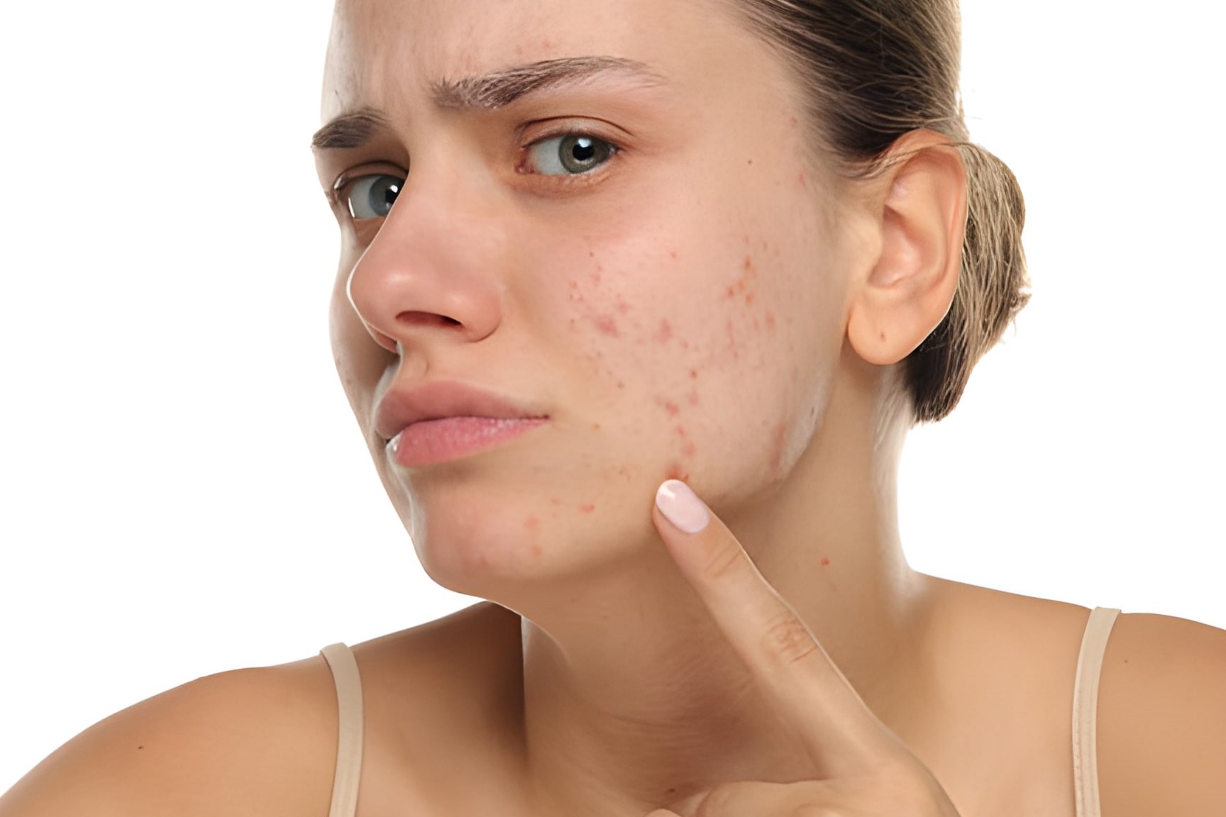 Bukan Skincare, 6 Gaya Hidup Ini Bikin Wajah Breakout tanpa Disadari!