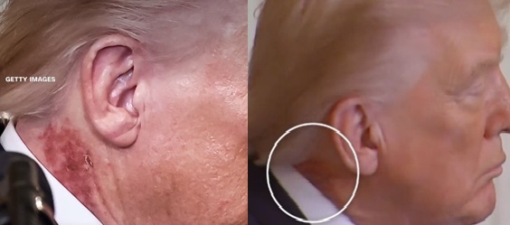 Di Leher Trump Muncul Bercak-Bercak Merah, Sakit Apa? Dokter Kepresidenan Gedung Putih Buka Suara