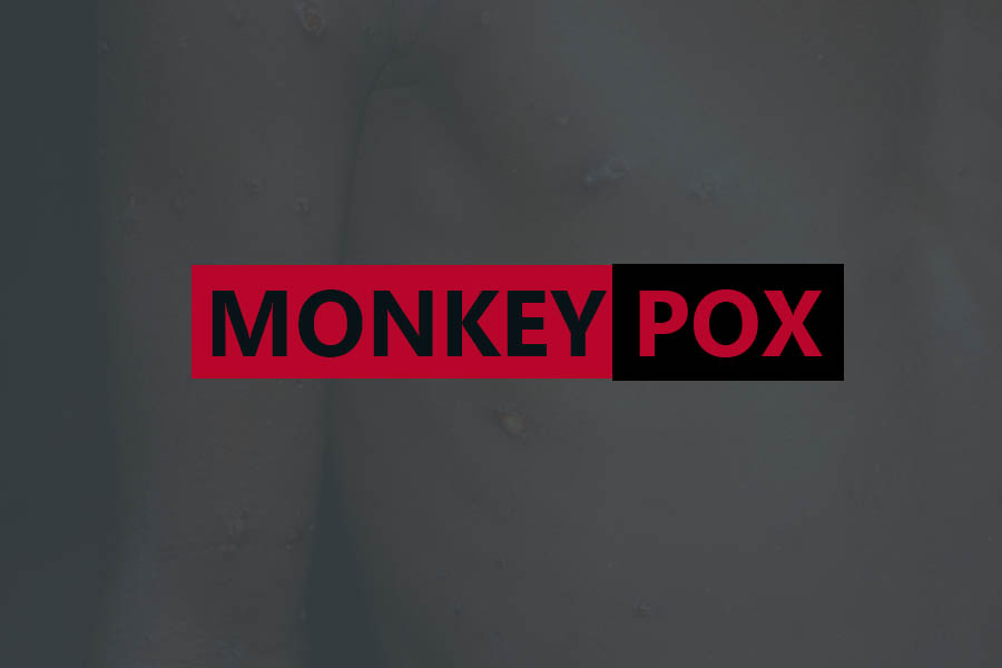 Wabah Monkeypox Menyebar di Eropa