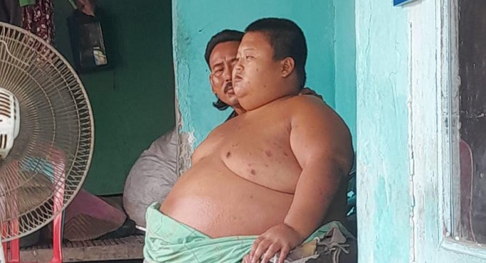 Sebelum Meninggal, Bocah Obesitas asal Bekasi Mengeluh Sesak Nafas