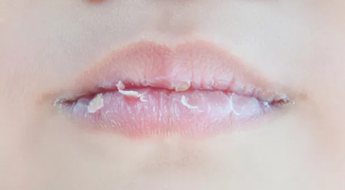 Bukan Cuma Dehidrasi, Ini 4 Penyebab Bibir Sering Pecah-Pecah yang Sering Diabaikan