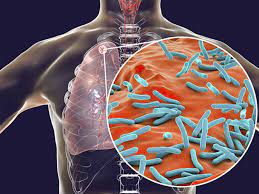 Waspada Tuberkulosis, Ayo Kenali Gejala dan Cara Pencegahannya