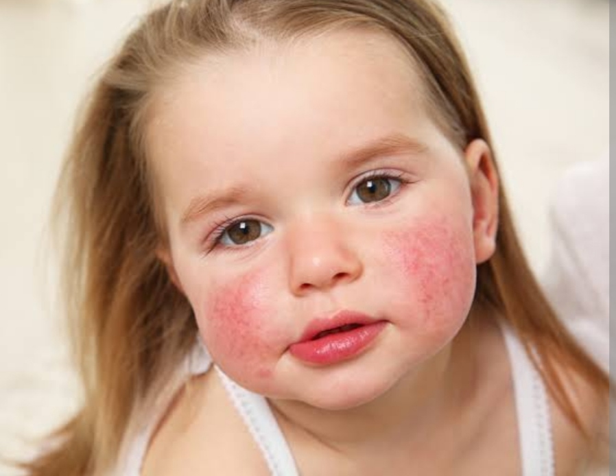 Jangan Dianggap Sepele, Kenali Gejala Alergi pada Anak dan Pemicunya
