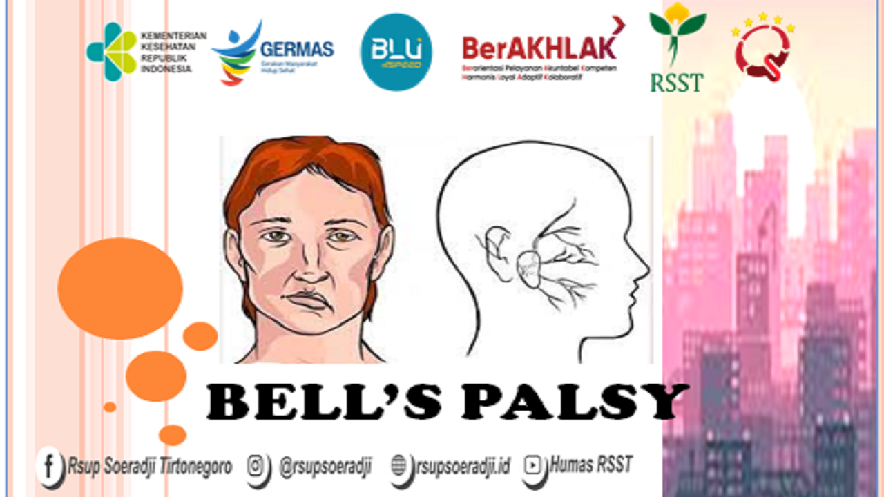  Mitos atau Fakta? Kipas dan AC Sebabkan Bell’s Palsy