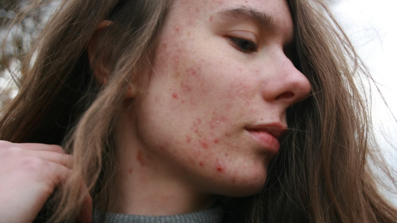 Cara Aman Atasi Jerawat Tanpa Iritasi, Rutin Pakai Bisa Kasih Dampak Besar