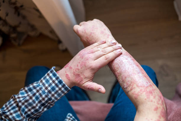 Mengenal 8 Jenis Psoriasis dan Cara Menanganinya dengan Tepat