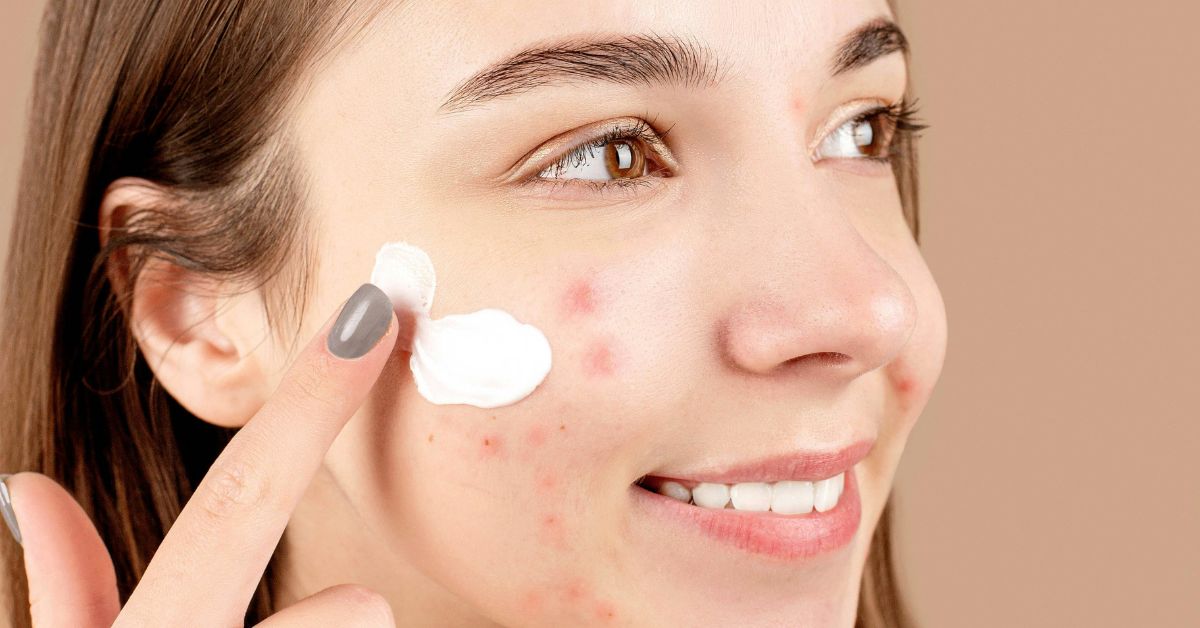 Perbedaan Jerawat dan Fungal Acne serta Cara Penanganannya