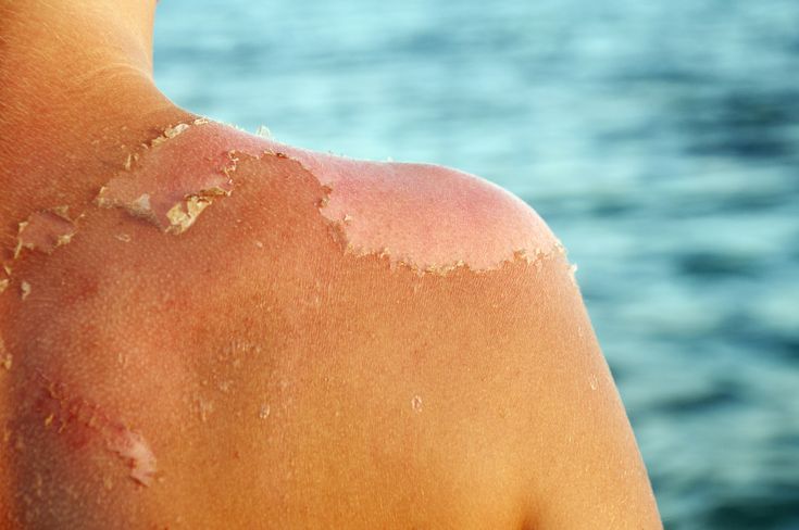 4 Tips Menghindari Kulit Belang dan Kering di Cuaca Panas