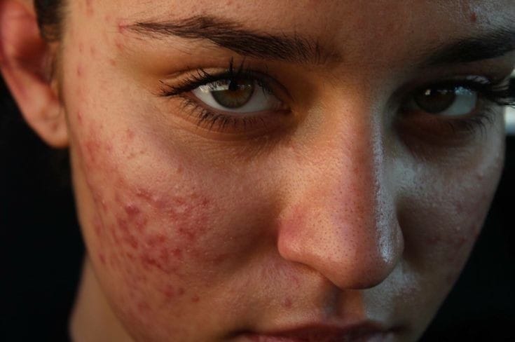 Ada 10 Kesalahan Umum yang Harus Dihindari Bagi Pemilik Kulit Acne Prone