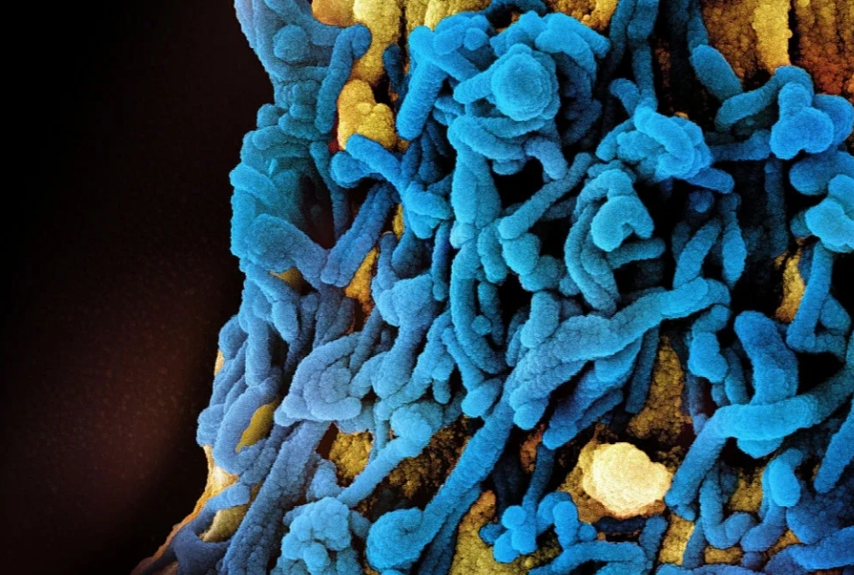 Wabah Virus Marburg Ditemukan di Ethiopia, Waspada Gejala-Gejala Ini yang Lebih Parah dari Ebola