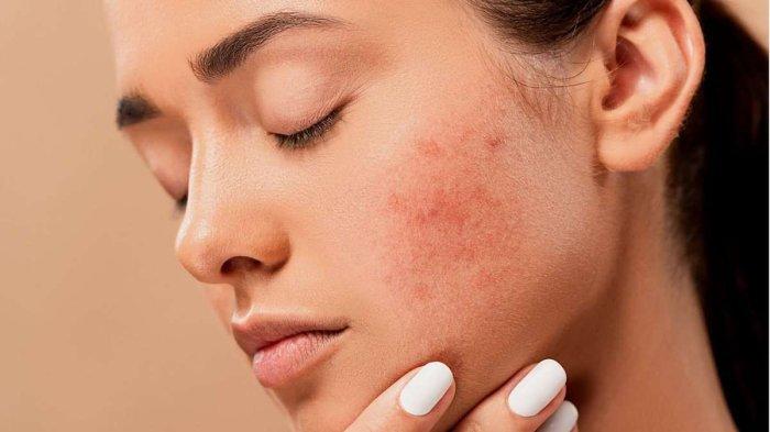 Apakah Anda memiliki kulit sensitif?  Ikuti 5 tips memilih perawatan kulit yang tepat