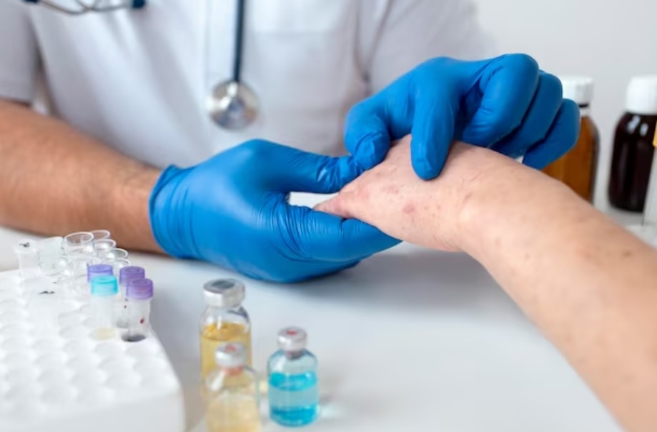 Pemerintah Siapkan Vaksinasi dan Langkah Lain Untuk Mencegah Penyebaran Virus Monkeypox
