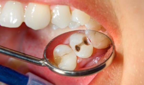Catat, Ini Jenis Perawatan Gigi yang ditanggung BPJS Kesehatan