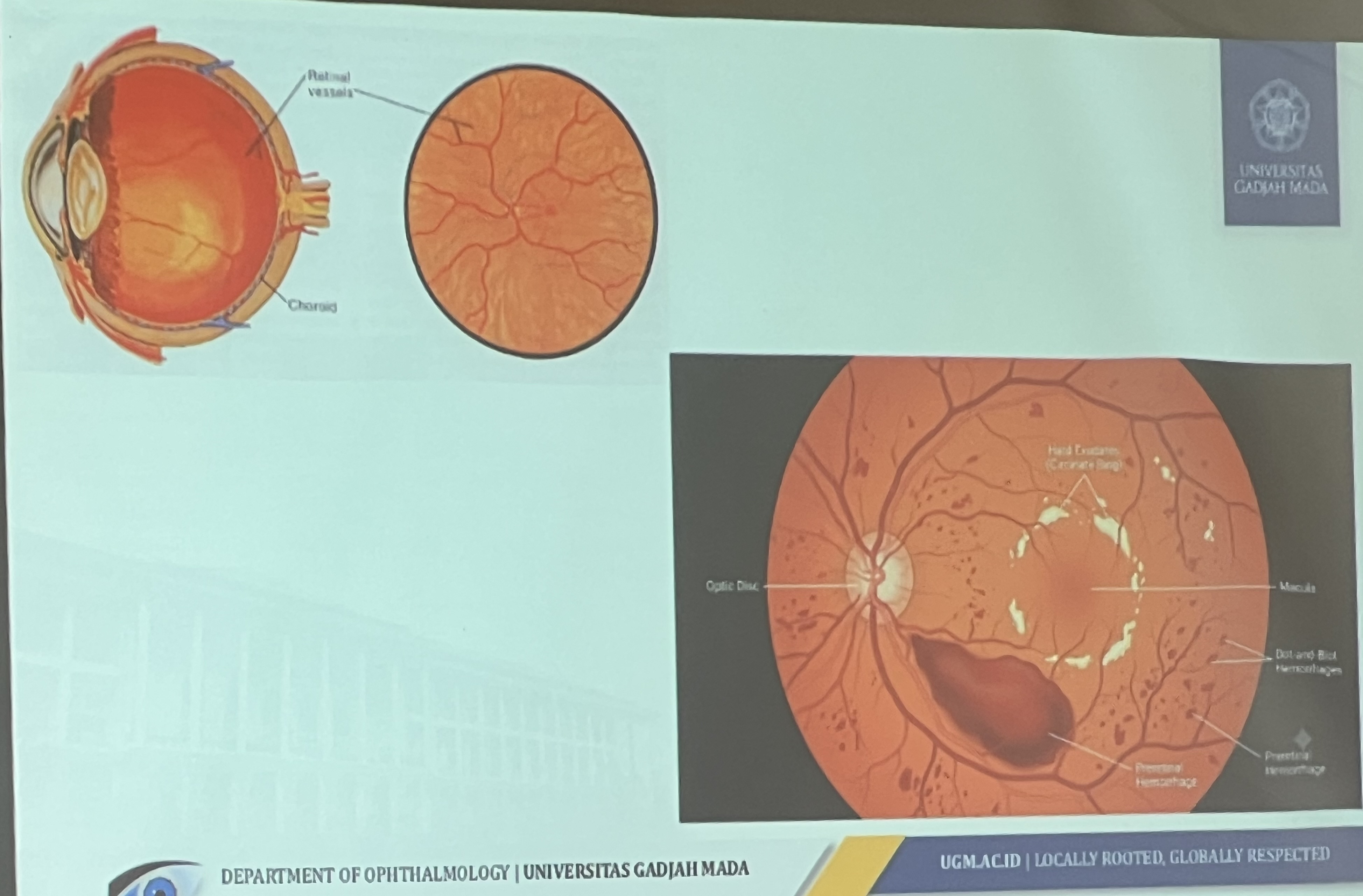 Diabetes Mengintai Mata, 70 Persen Kasus Tak Terdeteksi Picu Risiko Buta