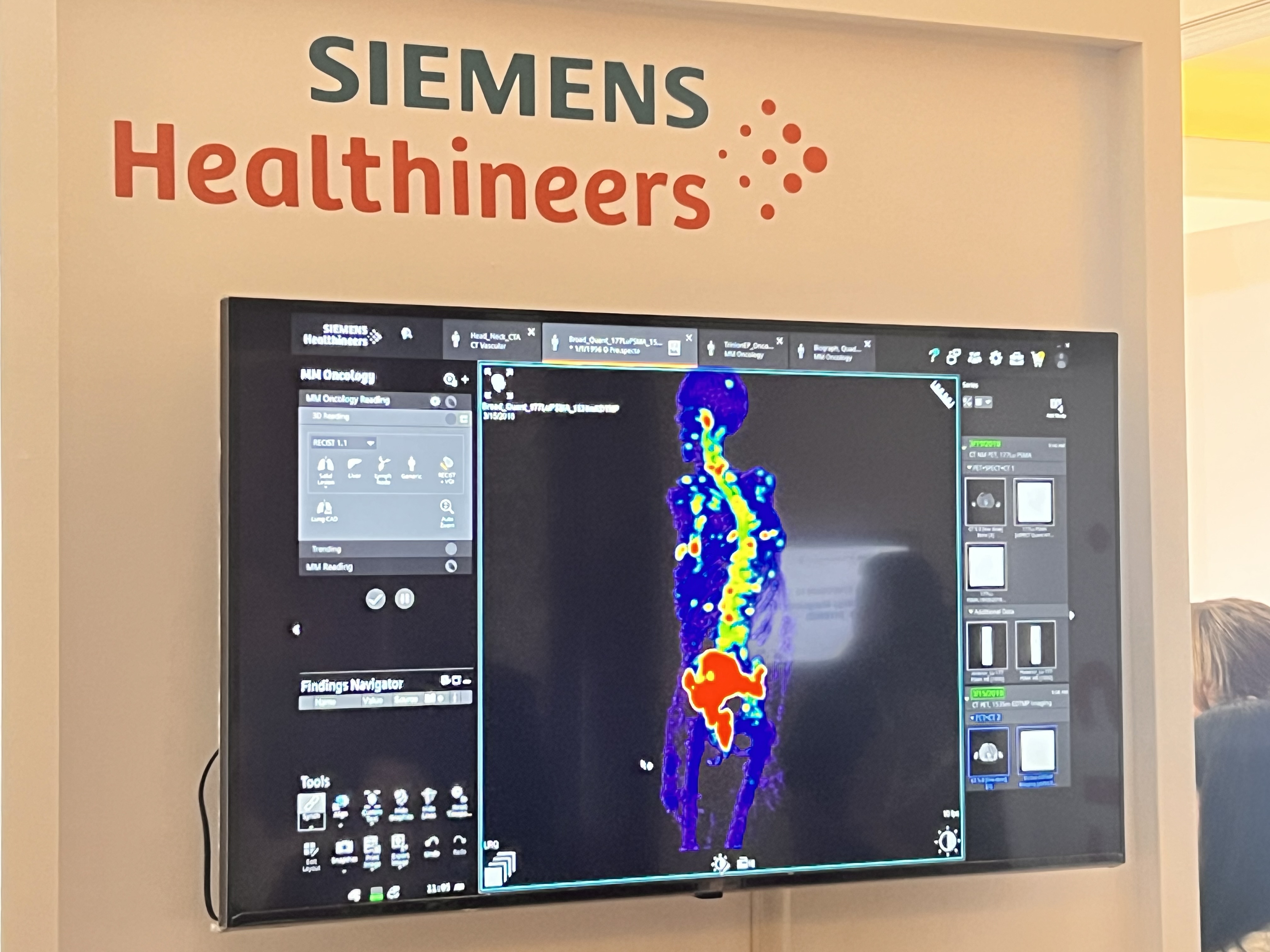 Siemens dan Siloam Perkuat Teknologi Baru, Deteksi Kanker Makin Akurat