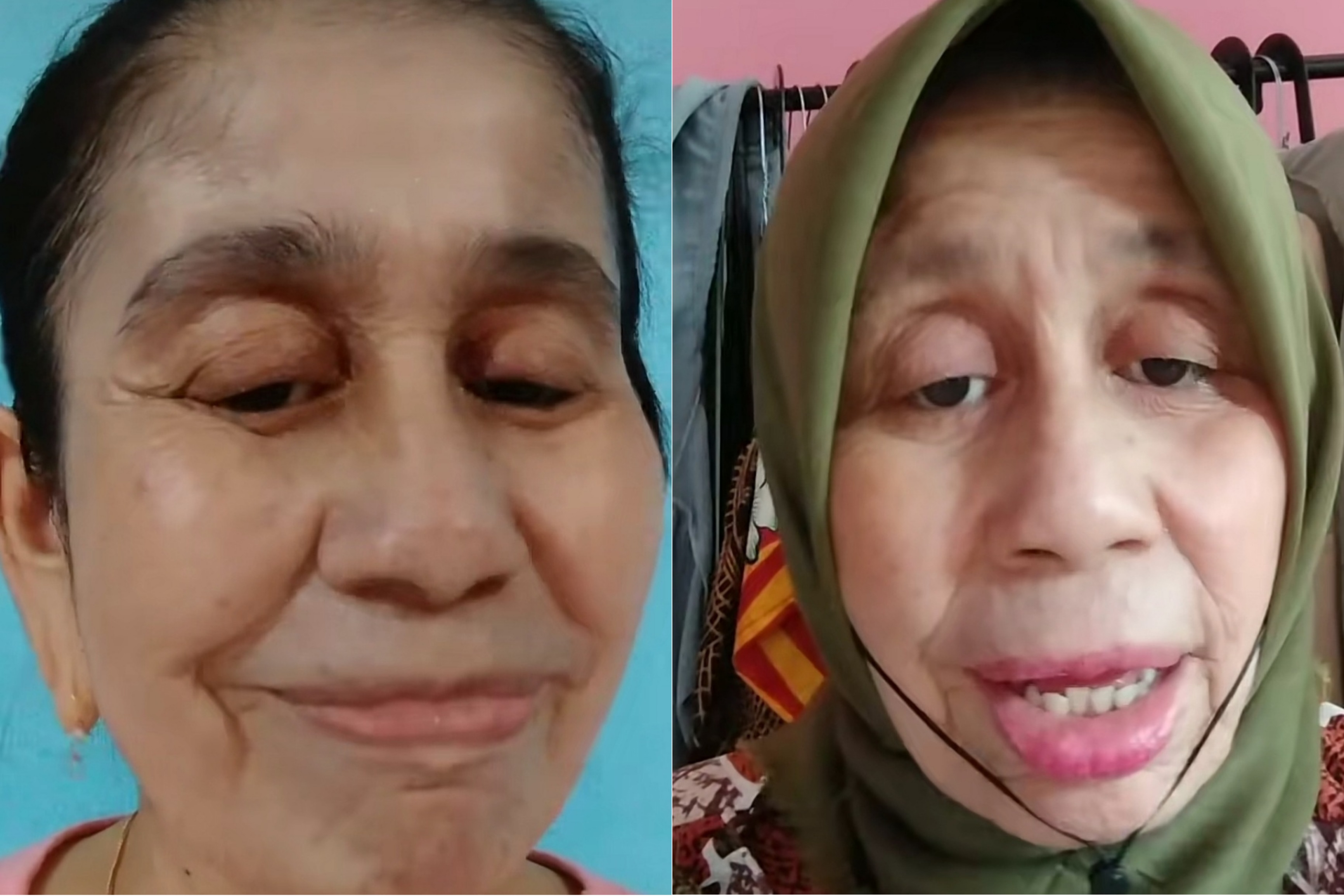 Viral Wajah Wanita Usia 28 Tahun di Bogor Seperti Nenek-nenek, Penyebabnya Terkuak Bukan Editan