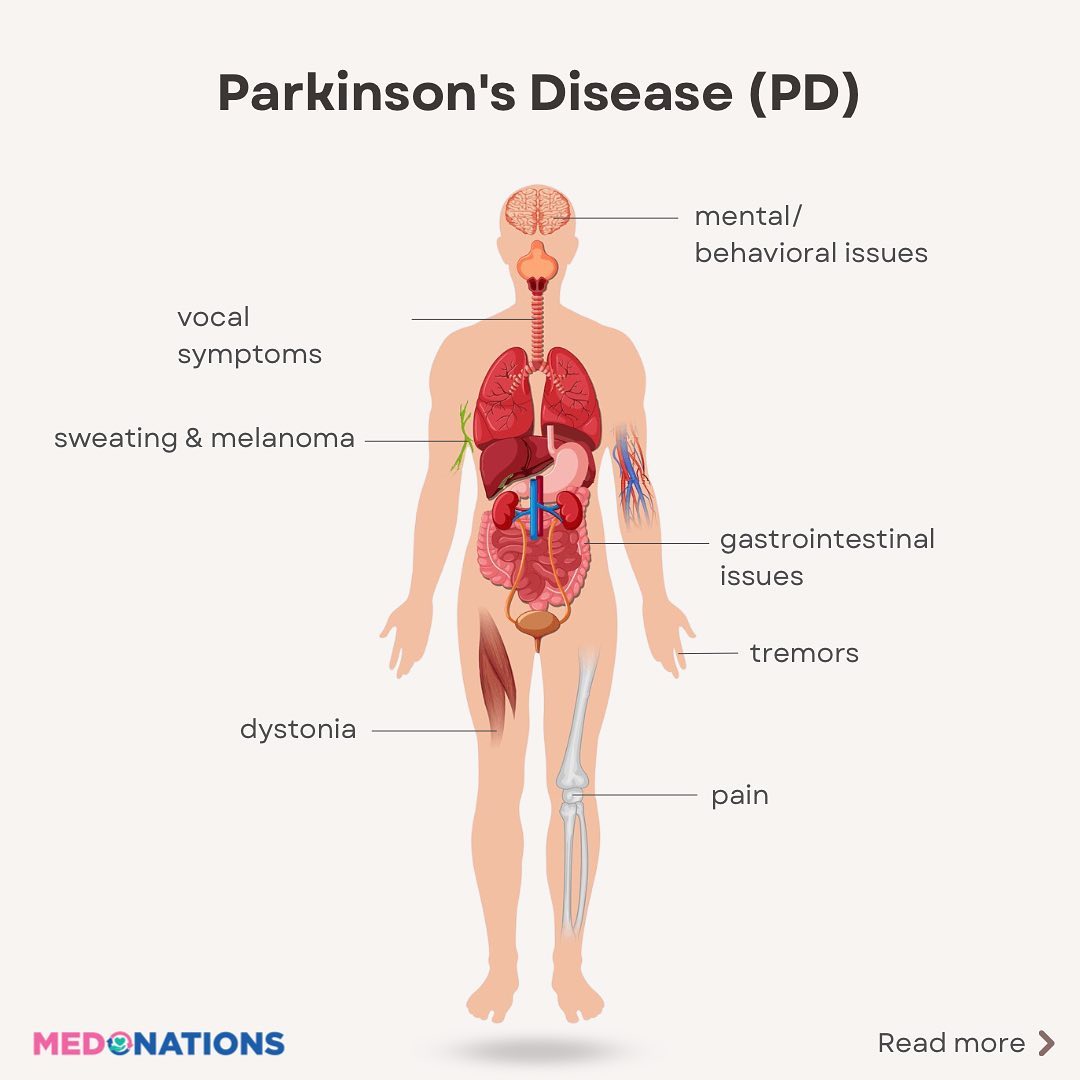 Empat Faktor Penyebab Parkinson dan Risiko Gangguan Neurodegeneratif