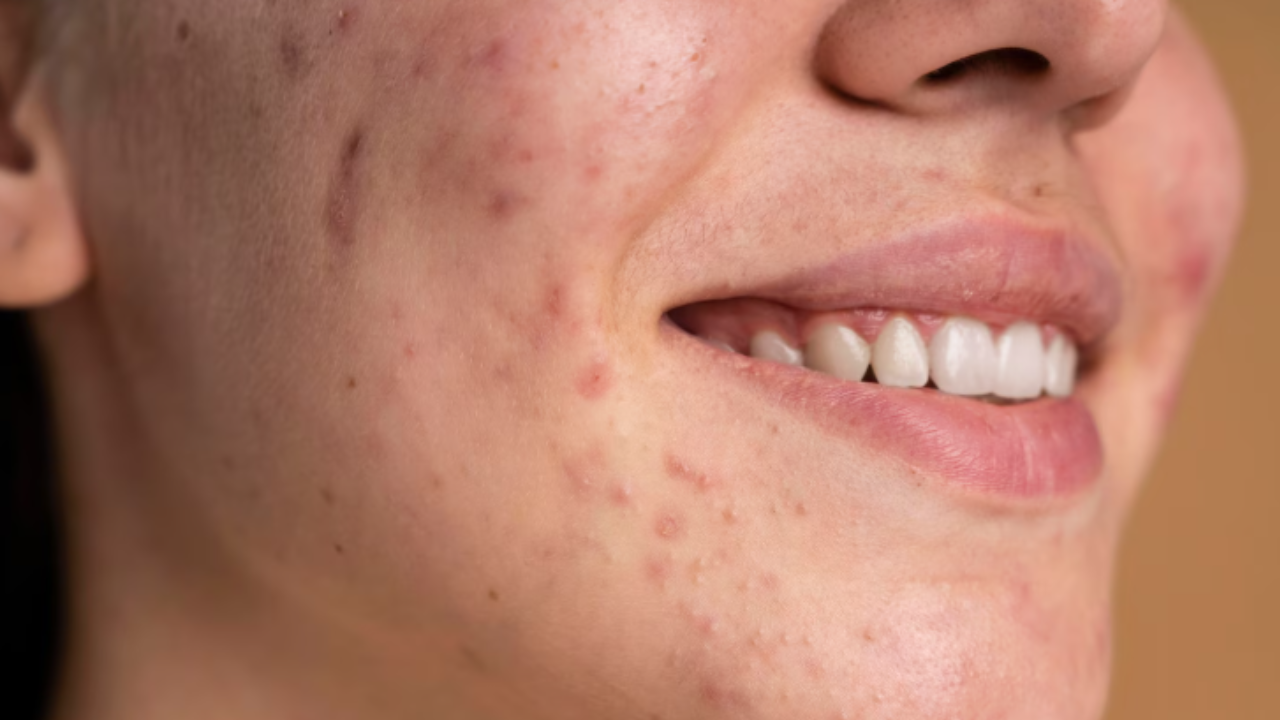 5 Cara Memperbaiki Skin Barrier Efektif, Dijamin Kulit Kembali Sehat