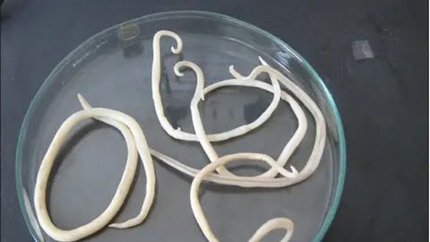 Bocah Raya Meninggal Akibat Tubuh Dipenuhi Cacing, Ahli Medis Ungkap Faktor Risiko dan Bahaya Tersembunyi!