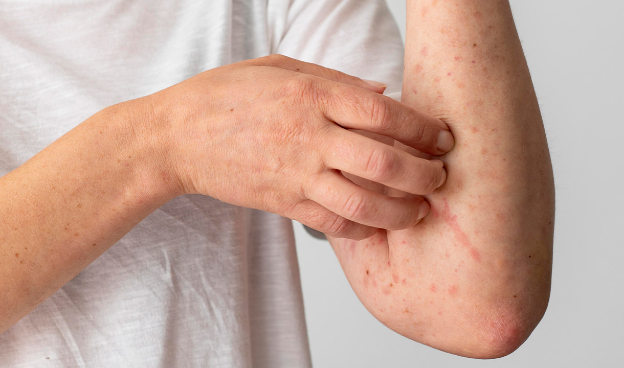 Kemenkes Pastikan Campak Terkendali, Pelacakan Kontak Diperketat 