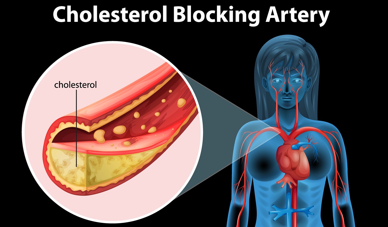 Dokter Temukan Cara Hapus Kolesterol Jahat dari Tubuh Tanpa Obat Seumur Hidup!