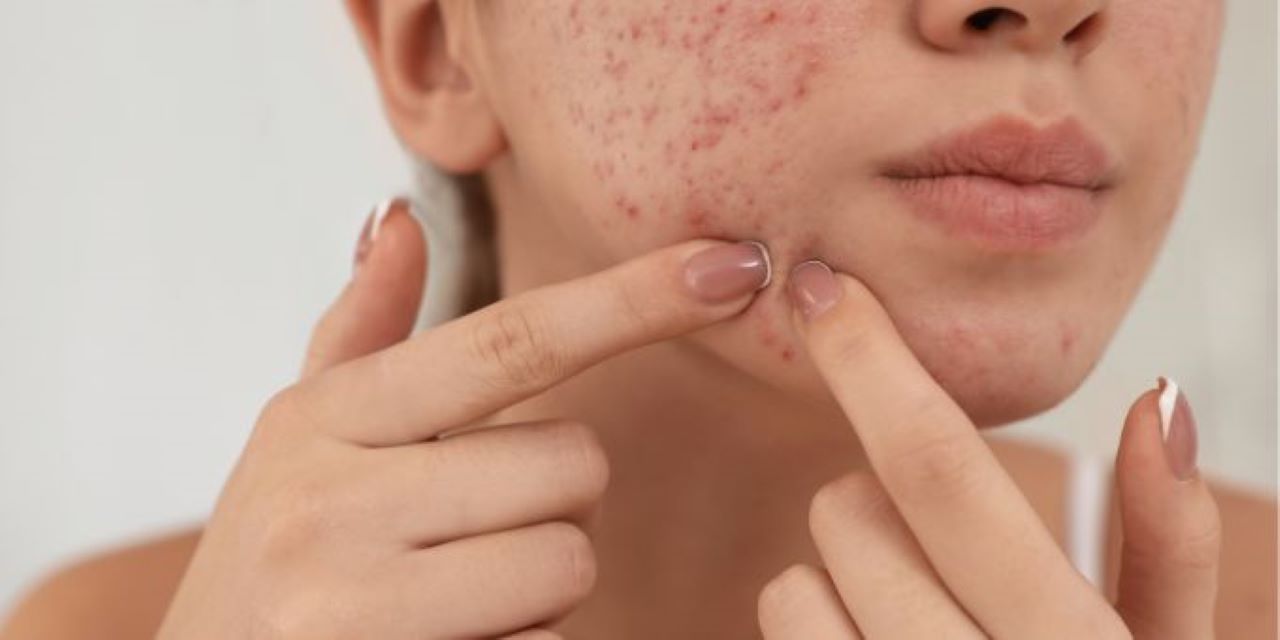 5 Tip Mengatasi Jerawat Hormonal Akibat Begadang dan Stres