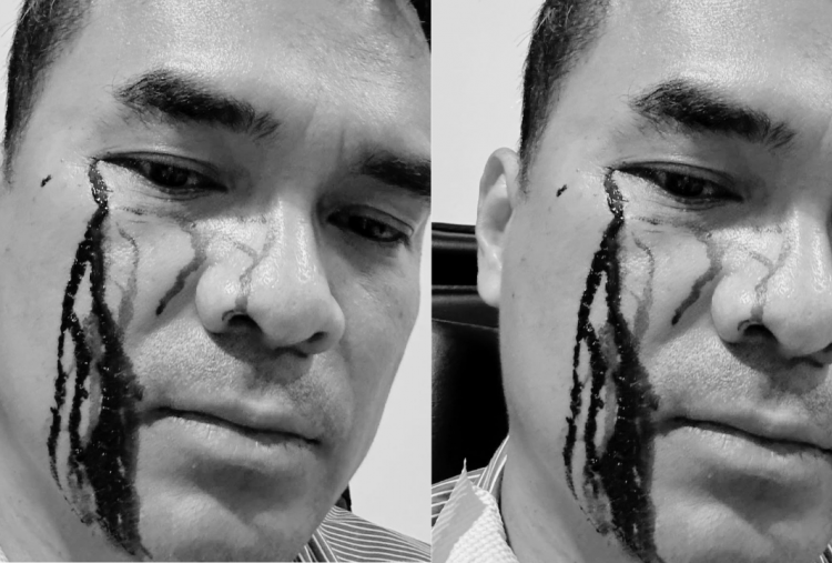 Penampakan Wajah Bro Ron Usai Dipukuli 2 Preman, Darah Mengucur di Pelipis Mata