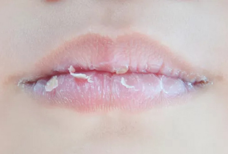 Bukan Cuma Dehidrasi, Ini 4 Penyebab Bibir Sering Pecah-Pecah yang Sering Diabaikan
