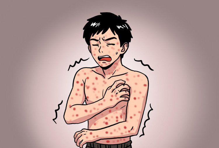 Campak, Herd Immunity, dan Tantangan Kesehatan Publik