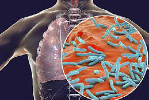 Tuberkulosis Jadi Global Emergency, WHO Melaporkan Seperempat Penduduk di Dunia Pernah Terjangkit