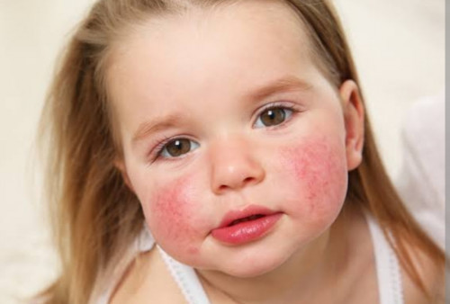 Jangan Dianggap Sepele, Kenali Gejala Alergi pada Anak dan Pemicunya
