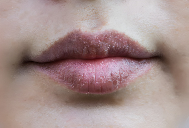 Alasan Bibir Tetap Kering Meski Sudah Pakai Lip Balm dan Cara Mengatasinya