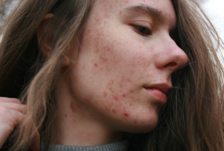 Cara Aman Atasi Jerawat Tanpa Iritasi, Rutin Pakai Bisa Kasih Dampak Besar