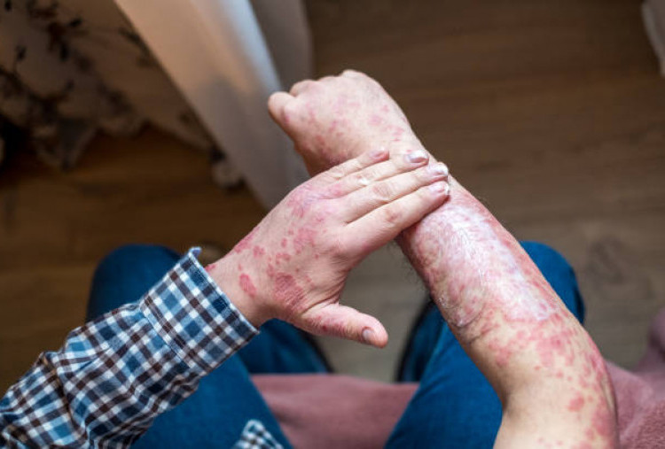 Mengenal 8 Jenis Psoriasis dan Cara Menanganinya dengan Tepat