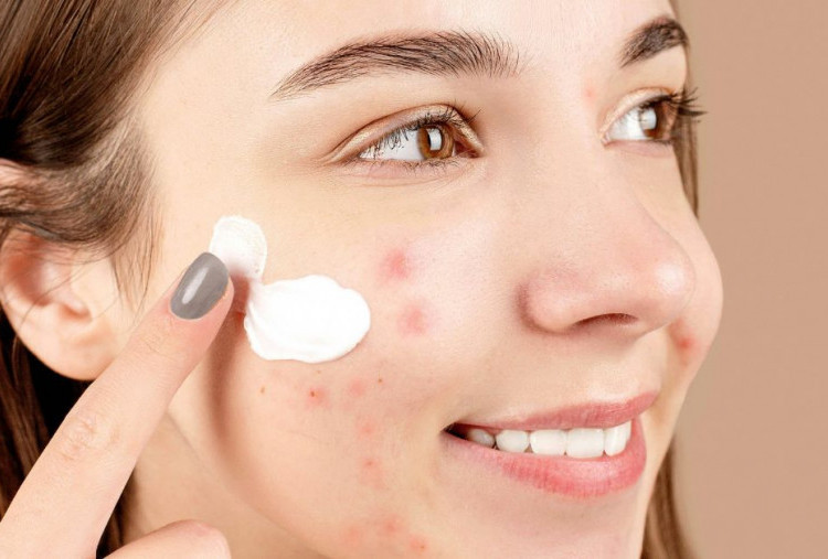 Perbedaan Jerawat dan Fungal Acne serta Cara Penanganannya