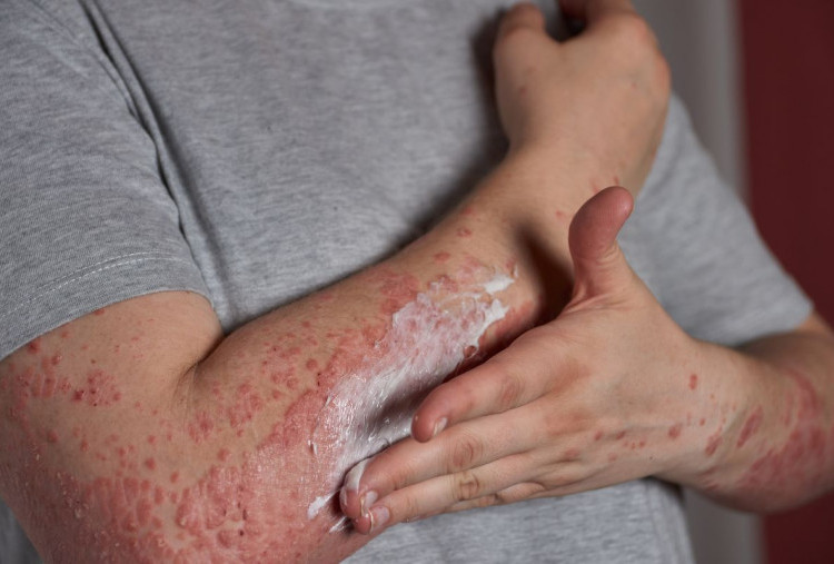 IDAI: Indonesia Masuk Top 3 Kasus Campak Tertinggi di Dunia, Hanya Kalah dari Yaman