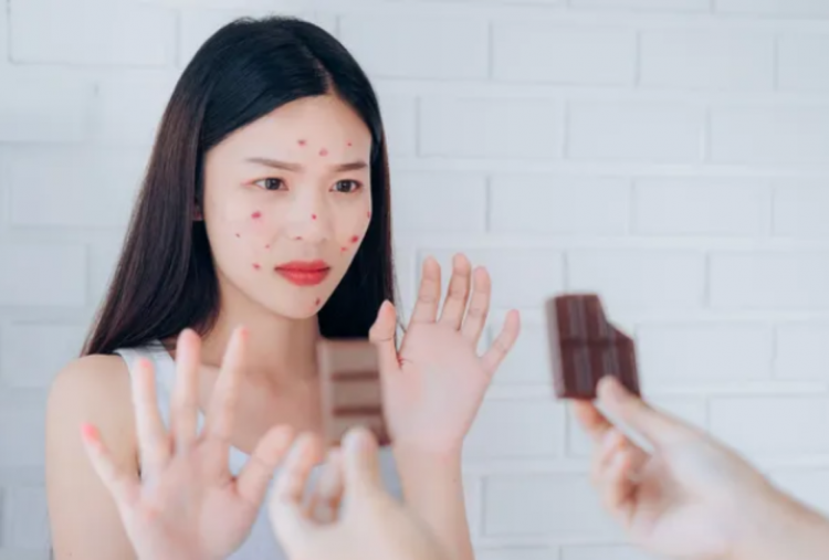 Cokelat Valentine Bikin Jerawatan, Fakta atau Mitos?