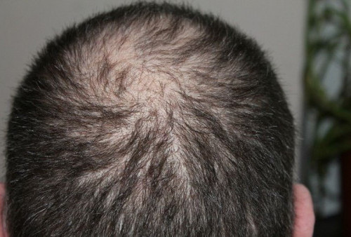 Penyakit Alopecia, Bahaya Banget Bisa Bikin Rambut Mendadak Rontok, Begini Cara Mencegahnya