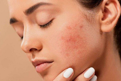 Anda Punya Kulit Sensitif? Ikuti 5 Tip Memilih Skincare yang Tepat
