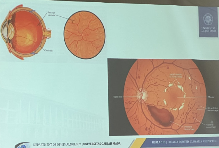 Diabetes Mengintai Mata, 70 Persen Kasus Tak Terdeteksi Picu Risiko Buta