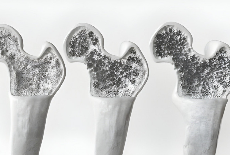 Kenali Tanda dan Cara Mencegah Osteoporosis sejak Usia Muda