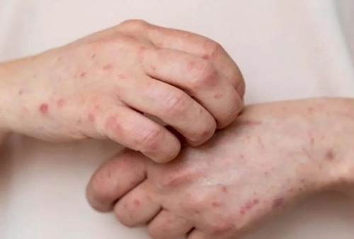 Penyakit Lupus: Gejala, Penyebab, dan Pengobatan