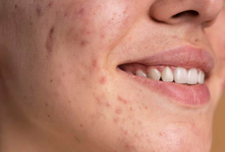 5 Cara Memperbaiki Skin Barrier Efektif, Dijamin Kulit Kembali Sehat