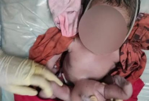 Bayi di India Lahir dengan 4 Tangan dan 4 Kaki
