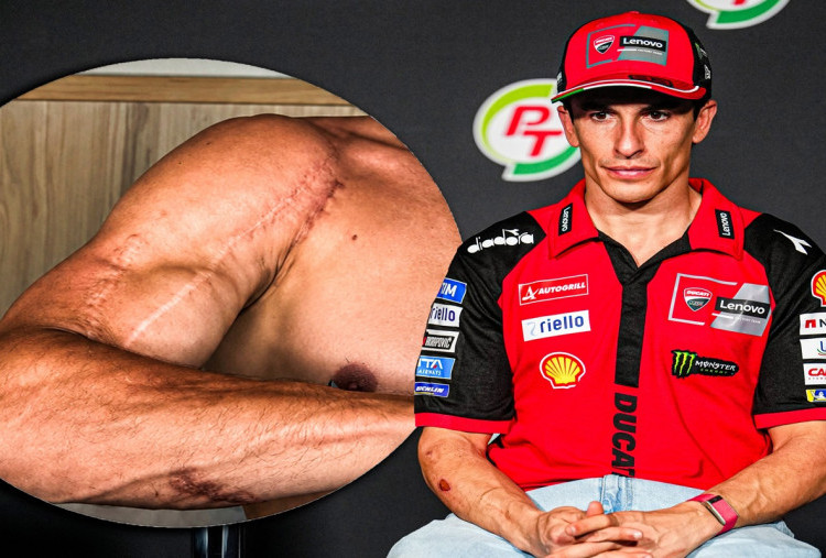 Bikin Merinding! Bekas Operasi Tangan Marc Marquez, Ducati Pastikan Sang Juara Dunia Kembali di Mugello