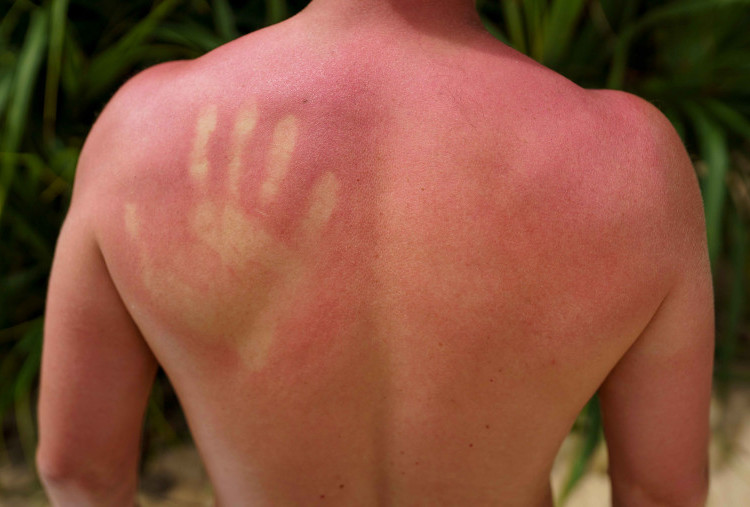 7 Tips Atasi Sunburn untuk Kulit Sensitif, Ampuh dan Bebas Iritasi