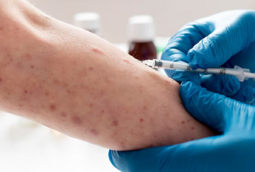 Virus Monkeypox Jadi Ancaman Dunia, WHO Sebut Cacar Monyet Berstatus 'Darurat Kesehatan Global'