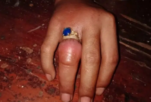 Cincin Tak Bisa Dilepas Hingga Jari Bengkak, Pria di Tangerang Ini Datangi BPBD